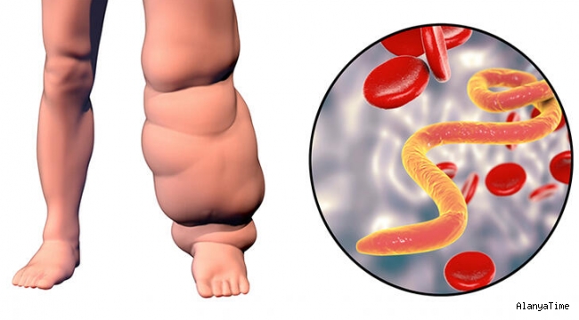 Lenf bezleri tıkanırsa bu hastalık ortaya çıkıyor! - Fil hastalığı (lenfödem) nedir?